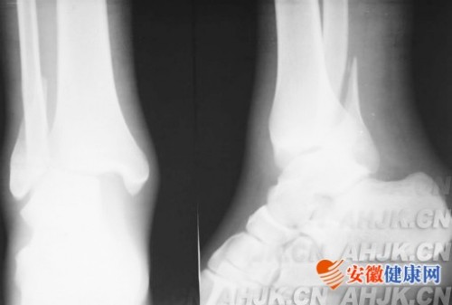 踝关节骨折并发症及处理方法