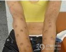 α1-抗胰蛋白酶缺乏性脂膜炎