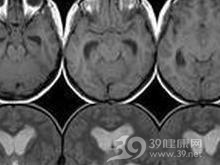 鞍上生殖细胞瘤