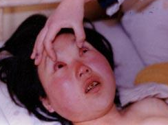 病毒性出血热