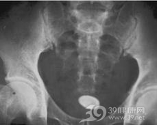 膀胱结石