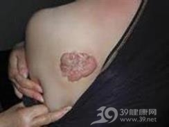 瘢痕癌