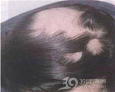 瘢痕性脱发