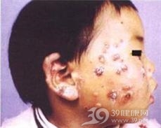 卟啉病