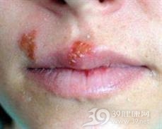 B疱疹病毒感染