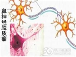 鼻神经胶质瘤