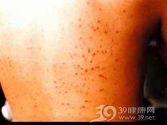 播散性复发性漏斗部毛囊炎