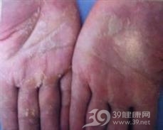 剥脱性角质松解症