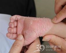 变异性红斑角化病