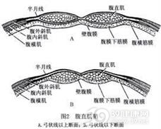 半月线疝