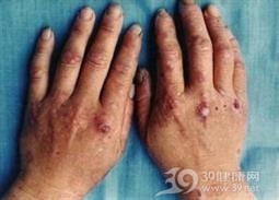 迟发性皮肤卟啉病