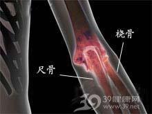 尺骨下1/3骨折合并下尺桡关节脱位