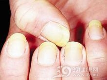 脆甲症