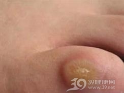 冲浪者结节