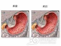 成人肥大性幽门狭窄