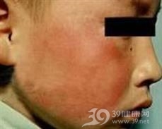传染性红斑