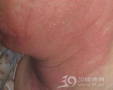 传染性湿疹样皮炎