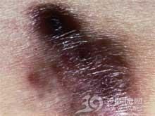 残胃平滑肌肉瘤