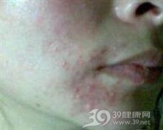 对苯二胺皮炎