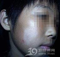 单纯糠疹