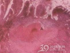 迪厄拉富瓦病
