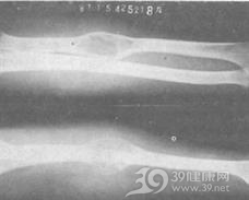 单房性骨囊肿
