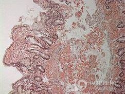 淀粉样变病和淀粉样关节病