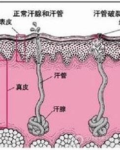 多汗症