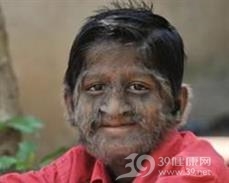 多毛症