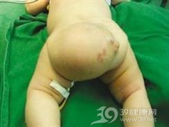 骶尾部畸胎瘤