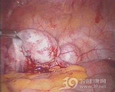 大网膜囊肿