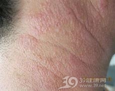 叠瓦癣