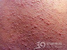 弹性假黄瘤