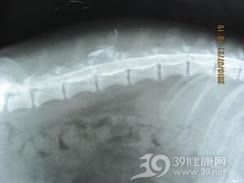 第Ⅰ型脊髓血管畸形