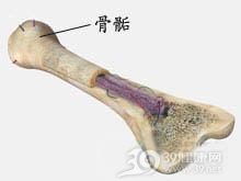 点状骨骺发育异常