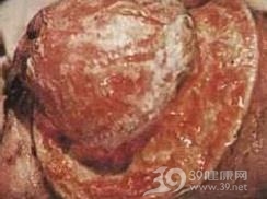二期梅毒