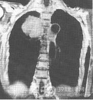 恶性淋巴瘤