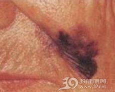 恶性雀斑样痣