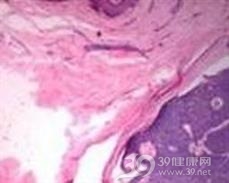 恶性小汗腺汗孔瘤