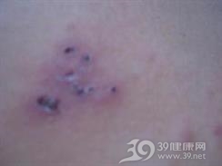 恶性小汗腺螺旋腺瘤