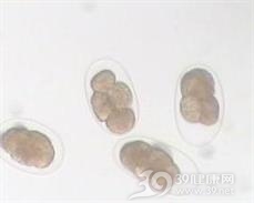 肺部钩虫病