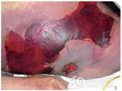 腹壁坏死性筋膜炎