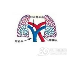 肺动静脉瘤