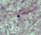 肥大细胞增多症