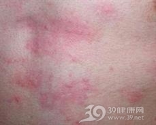 非典型麻疹综合征