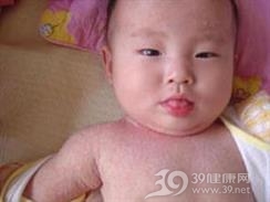 痱