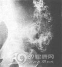 反分化软骨肉瘤