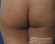 泛发性扁平黄色瘤