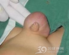 复发性腹股沟疝