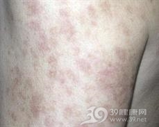 泛发性特发性毛细血管扩张